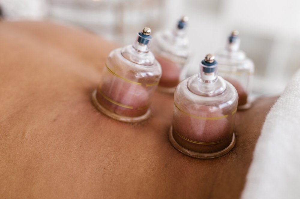 Cupping Therapy in Santa Monica | Westwood Physical Therapy